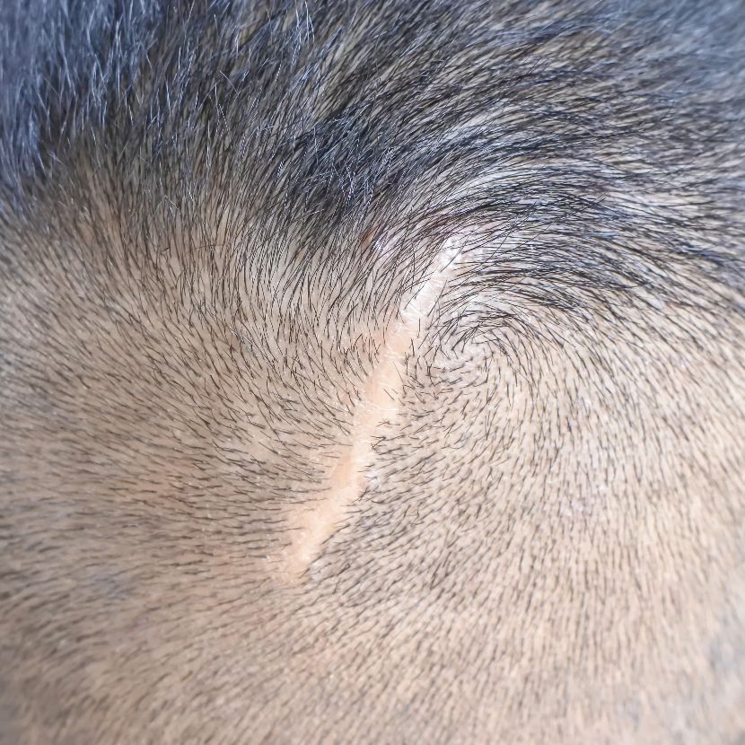 Scarring alopecia